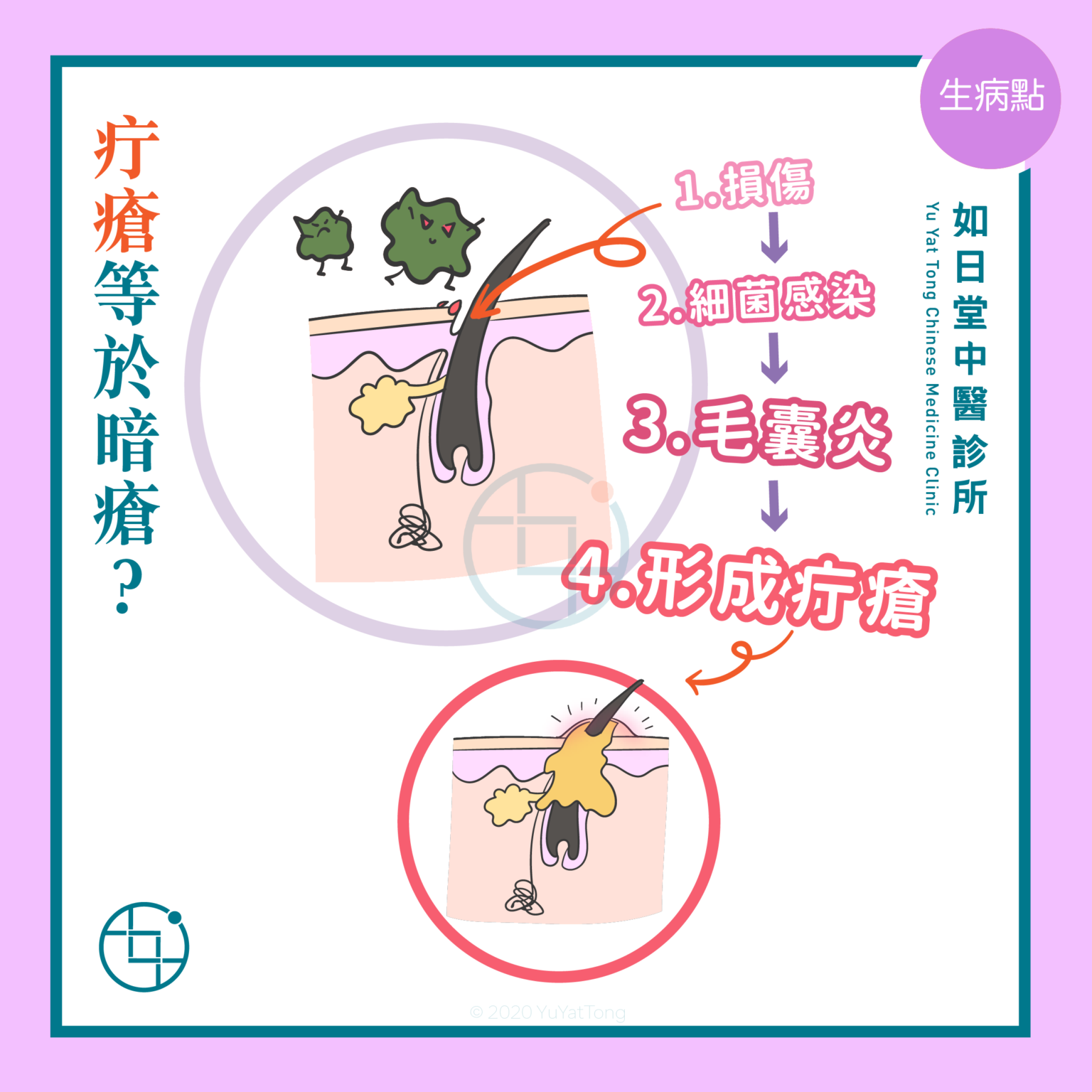 中醫看疔瘡 - 如日堂中醫診所 Yu Yat Tong Chinese Medicine Clinic